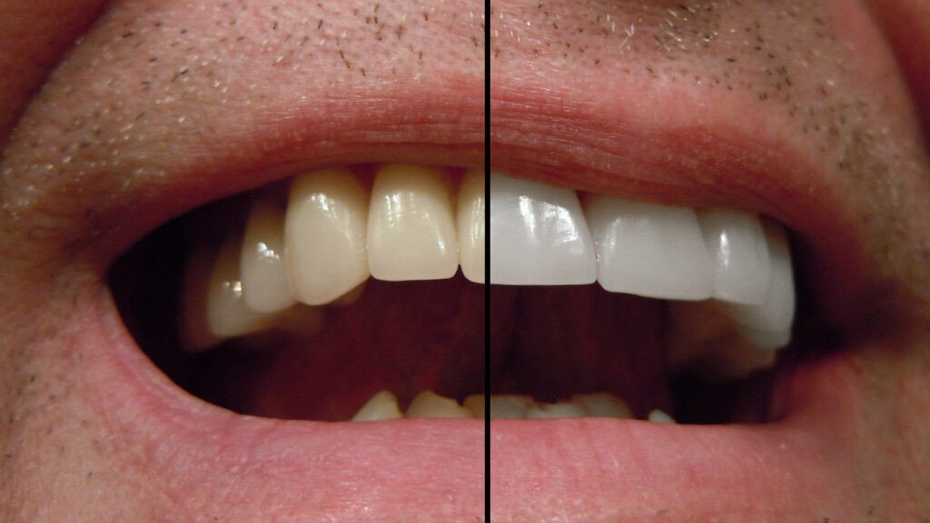 whiten teeth